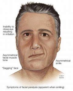 bell's palsy symptoms mayo clinic